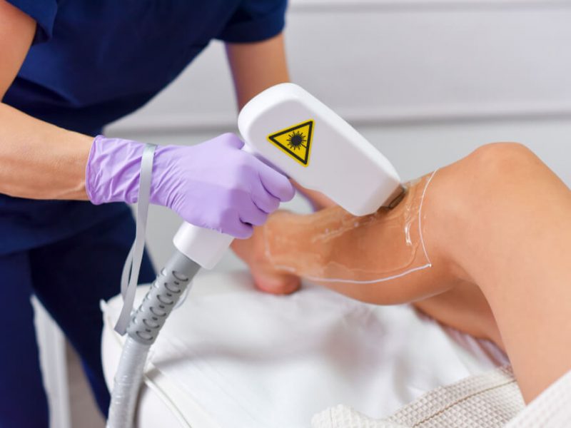 Diode Laser Hair Removal