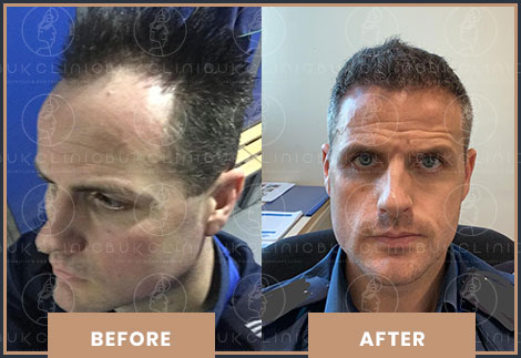 Hair Transplant Turkey Result