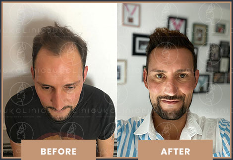 Hair Transplant Istanbul Result