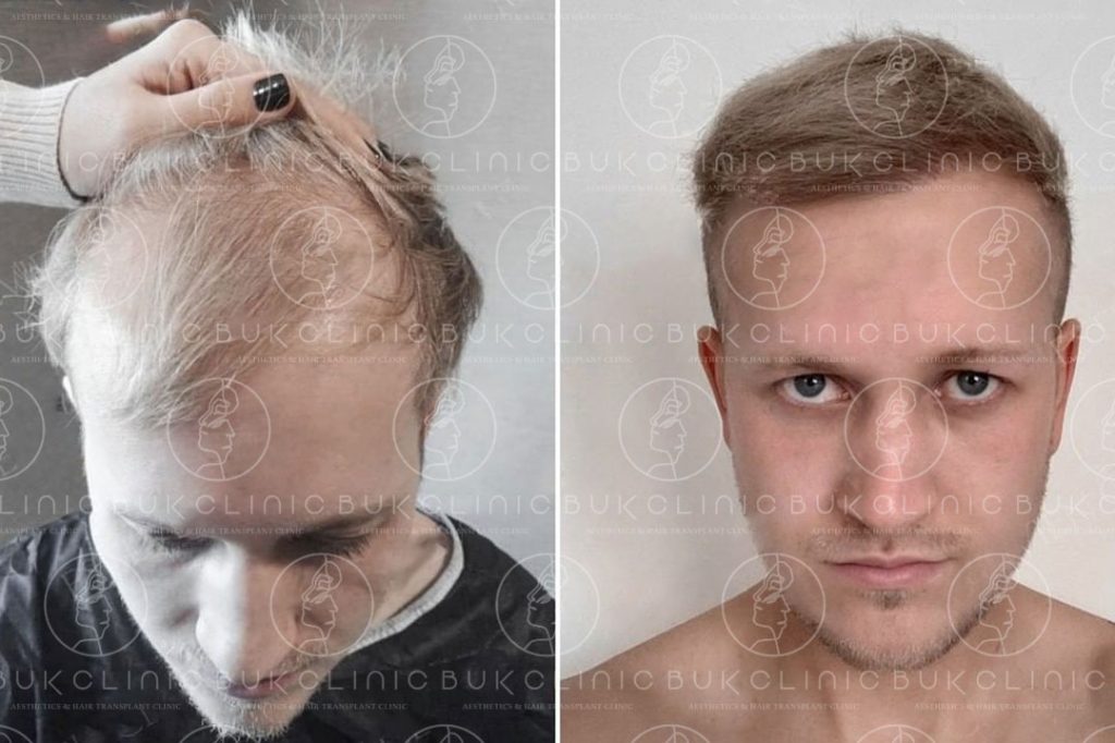 How many hair grafts are required for a hair transplant  Quora