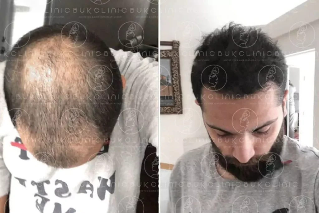 hair transplant before after