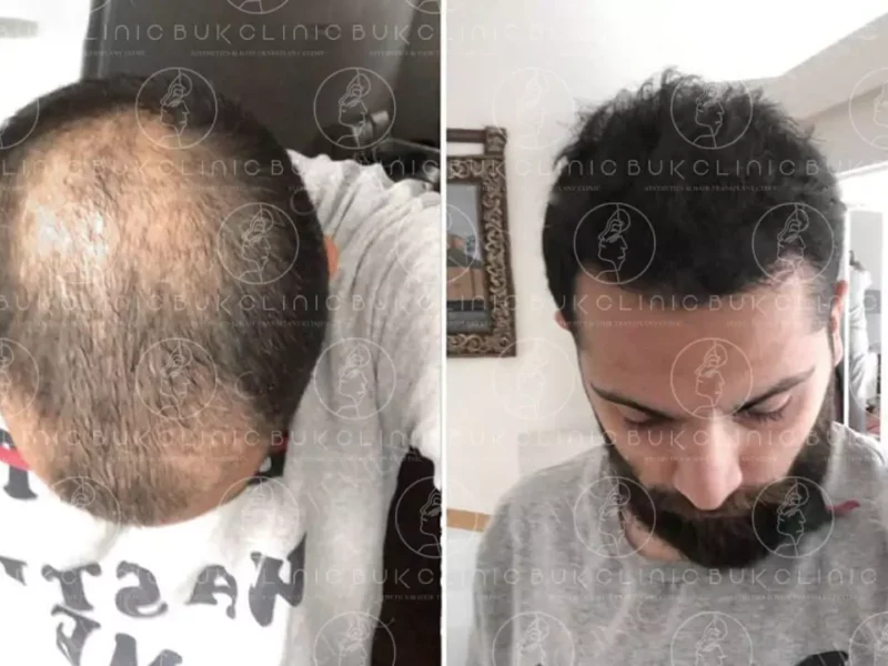 Hair Transplant Turkey