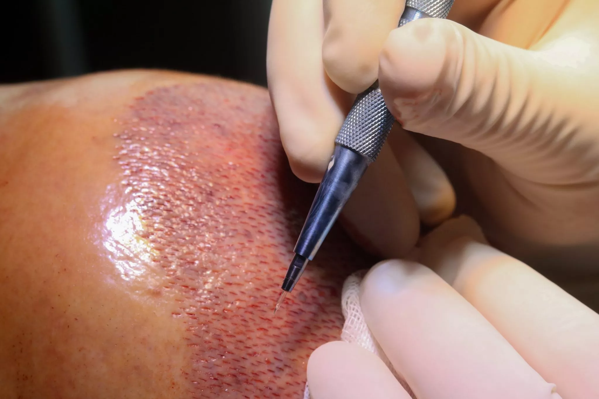 Sapphire Hair Transplant Turkey