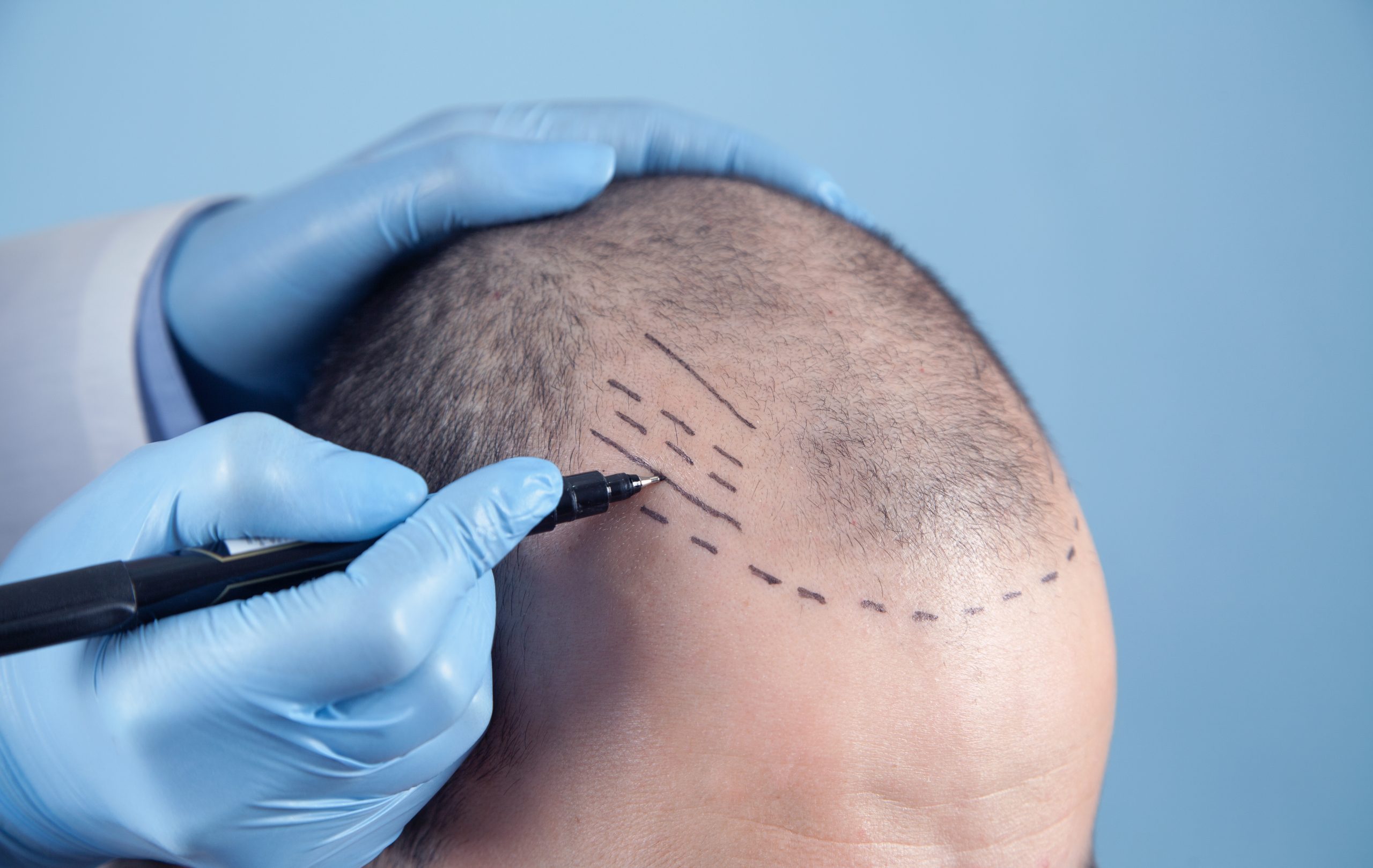 Explain The Success Rate of Hair Transplantation