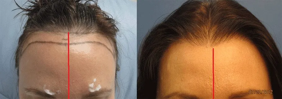 Hair Transplantation in Women