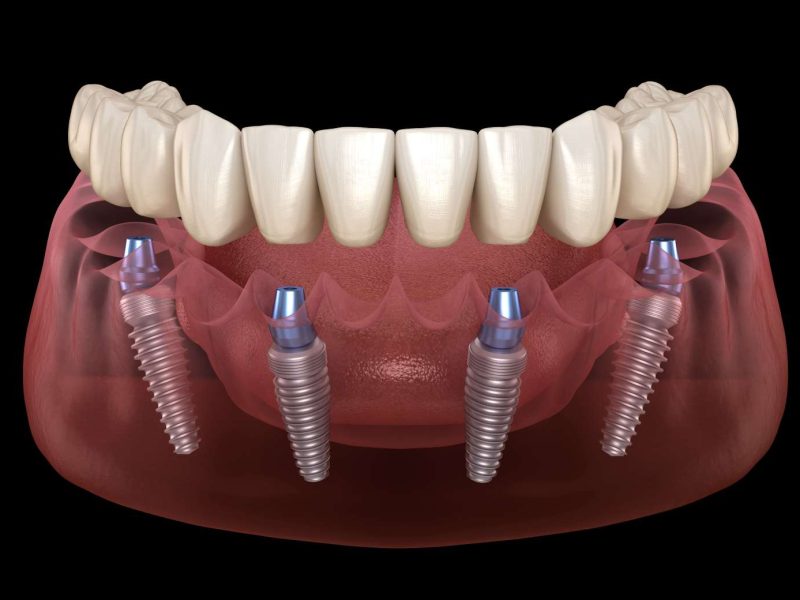 Dental Implant Turkey