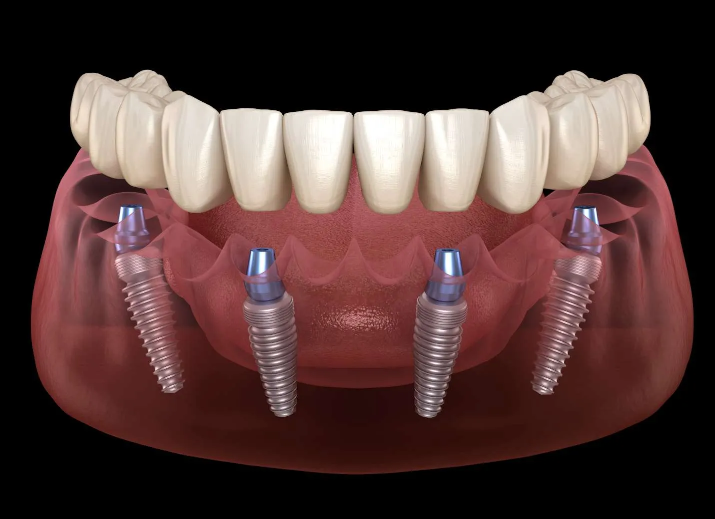 Dental Implant Turkey