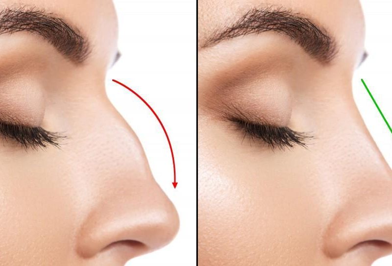 Rhinoplasty Turkey