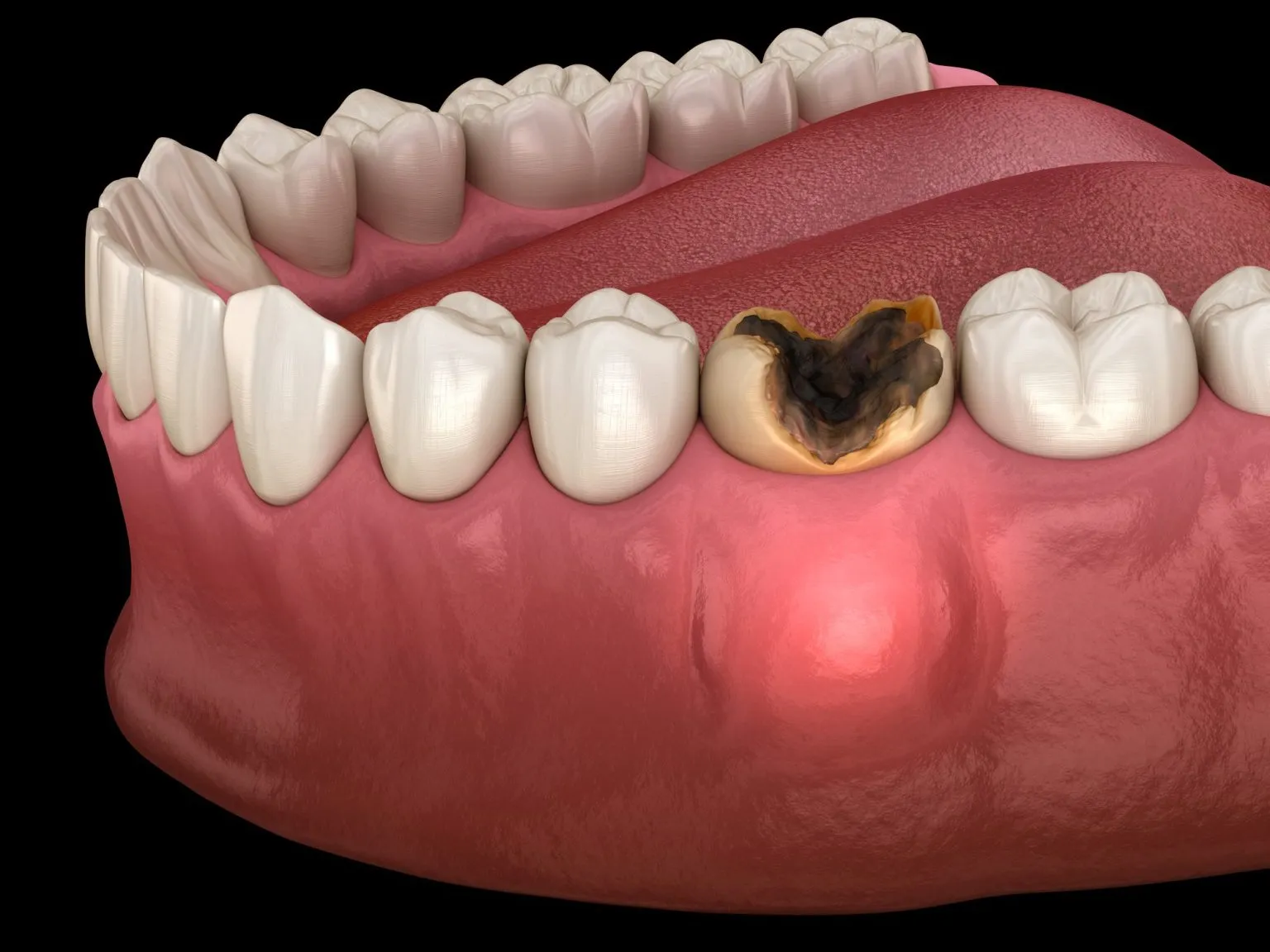 turkey teeth