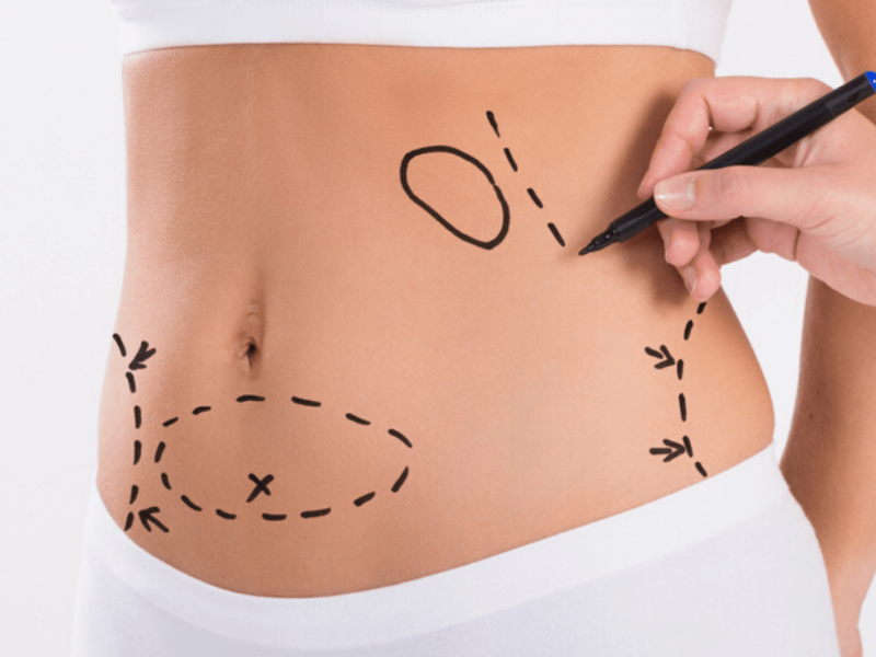 Liposuction Turkey