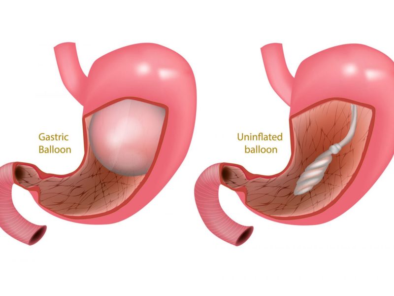 Gastric Balloon Turkey