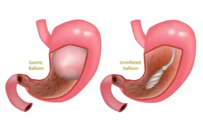 Gastric Baloon