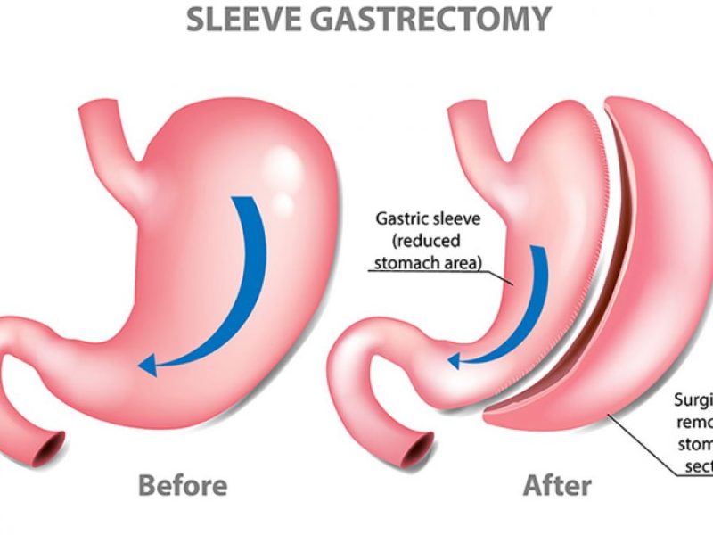 Gastric Sleeve Turkey