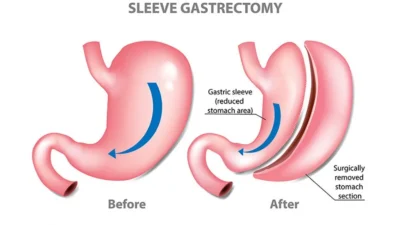sleeve gastrectomy