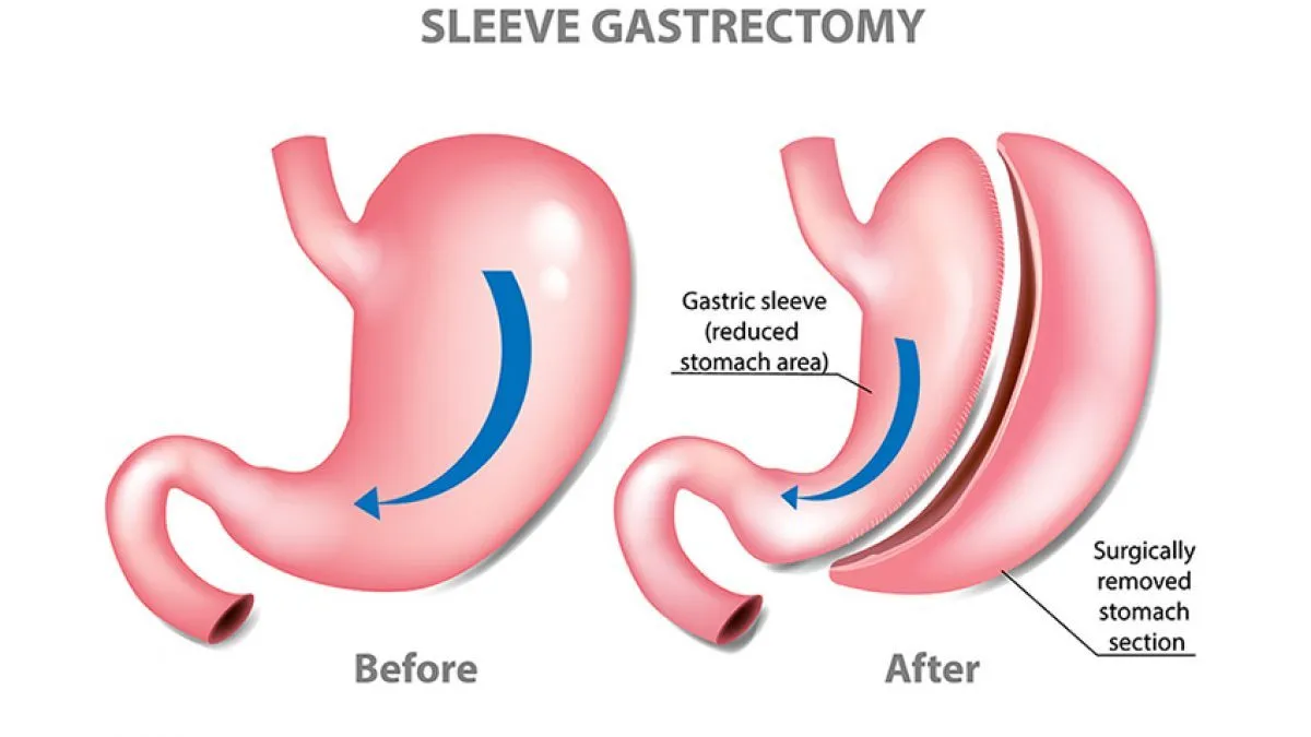 sleeve gastrectomy