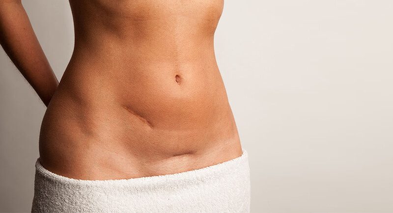 Tummy Tuck Turkey