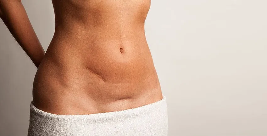 Tummy Tuck Turkey