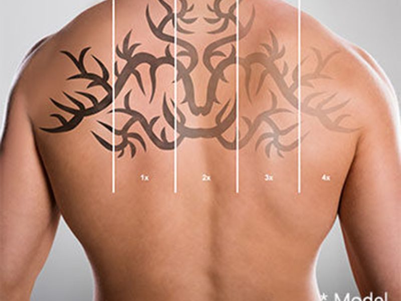 Tattoo Removal Turkey