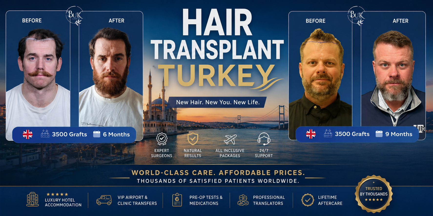 Hair Transplant Turkey