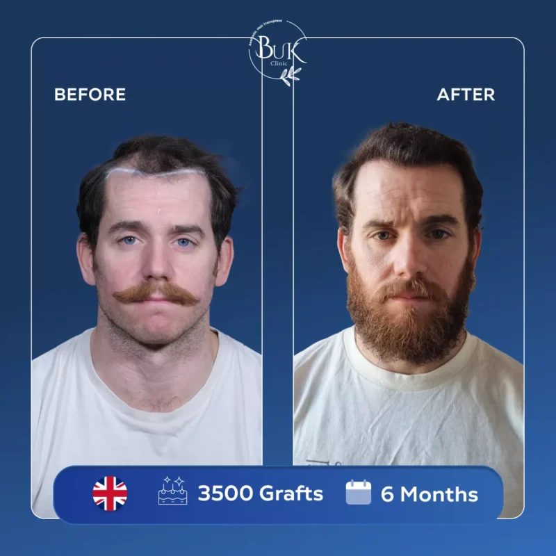 Hair Transplant Turkey