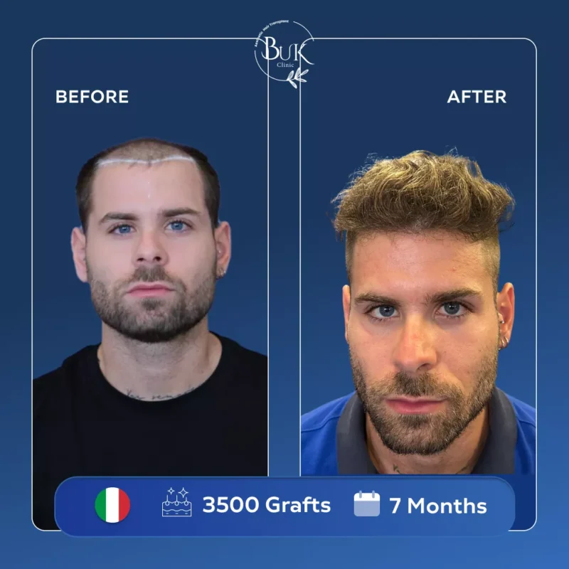 Hair Transplant Turkey
