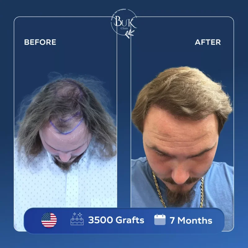 Unshaven Hair Transplant Turkey