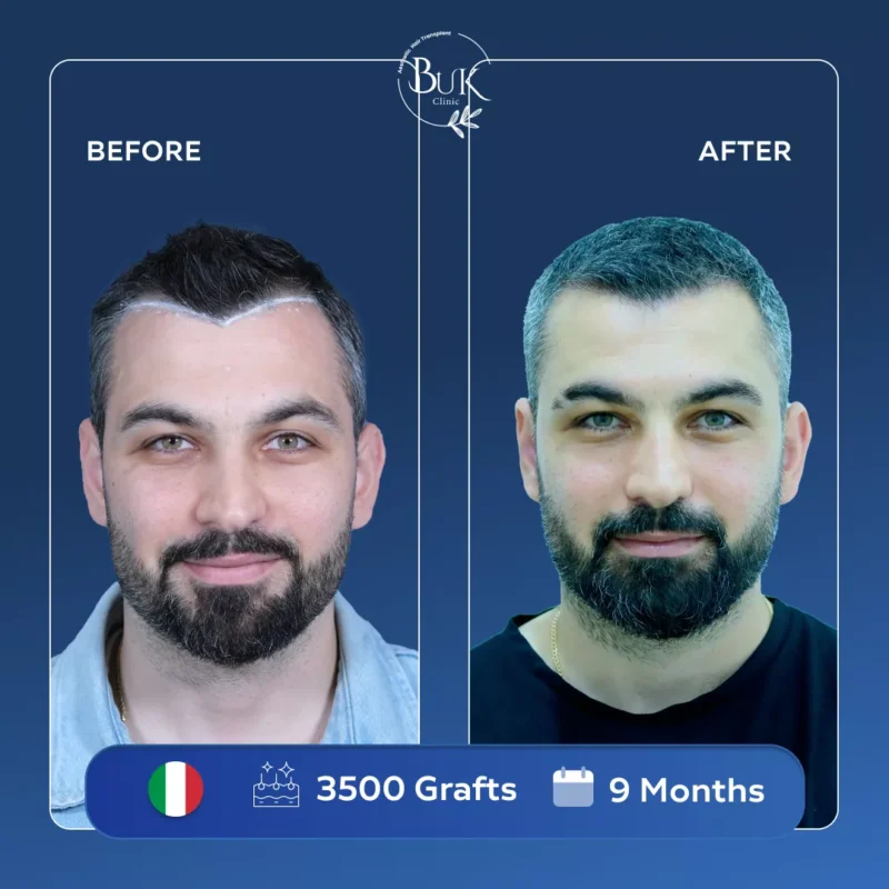 DHI Hair Transplant Turkey 3 DHI Hair Transplant Turkey