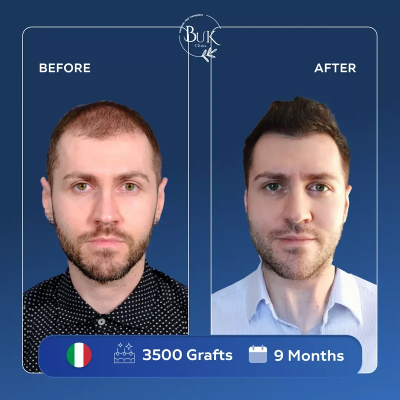 Fue Hair Transplant Turkey 2 Fue Hair Transplant Turkey