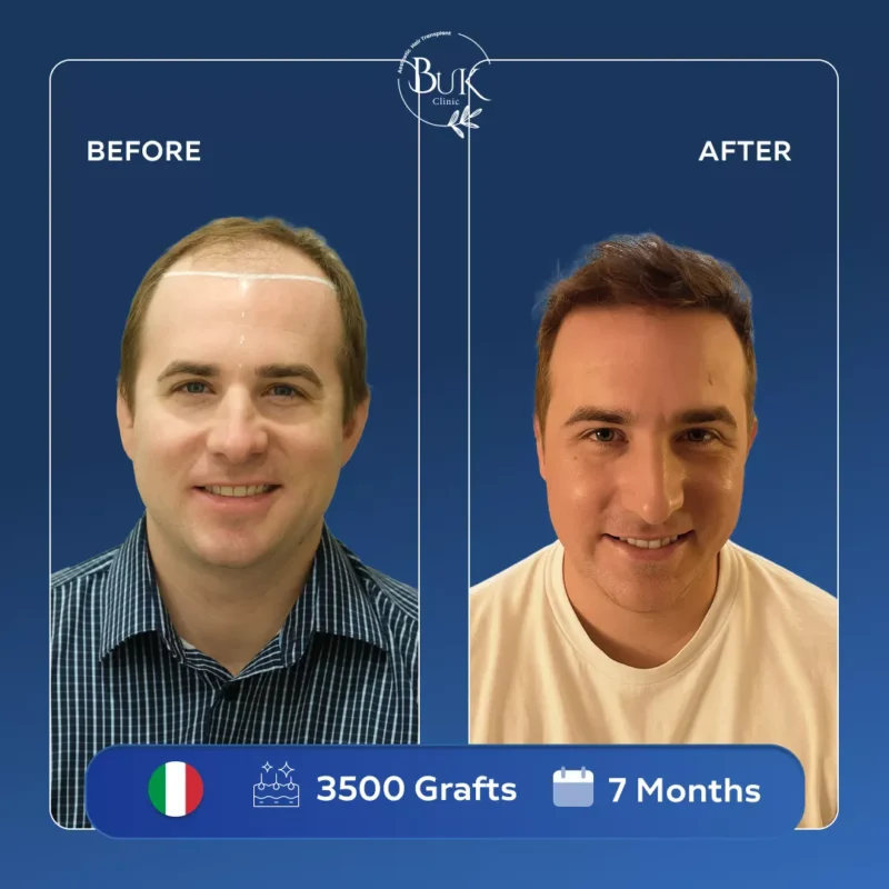Hair Transplant Turkey