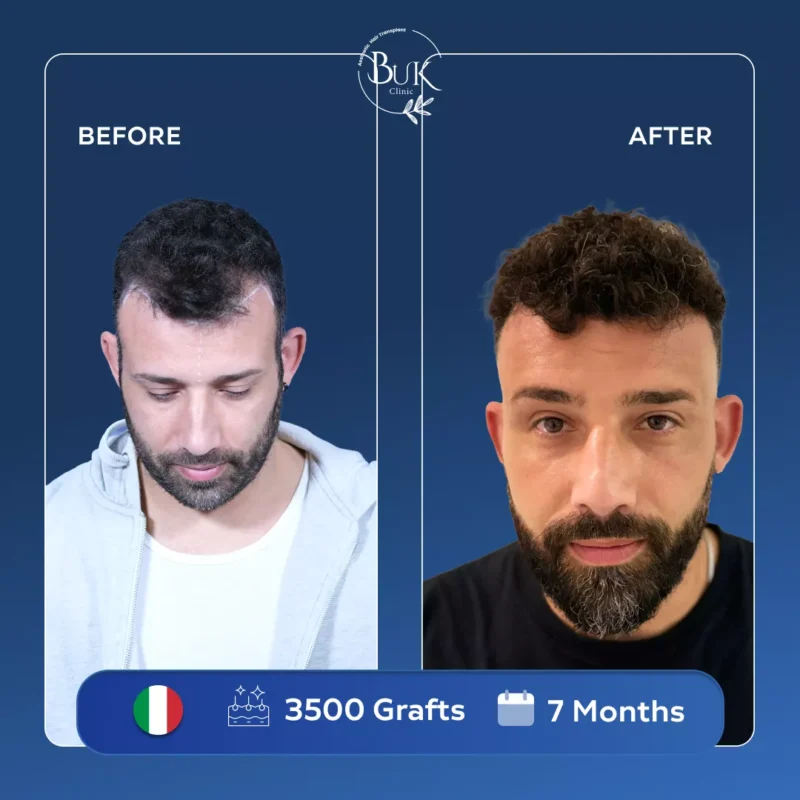 Sapphire Hair Transplant Turkey 2 Sapphire Hair Transplant Turkey