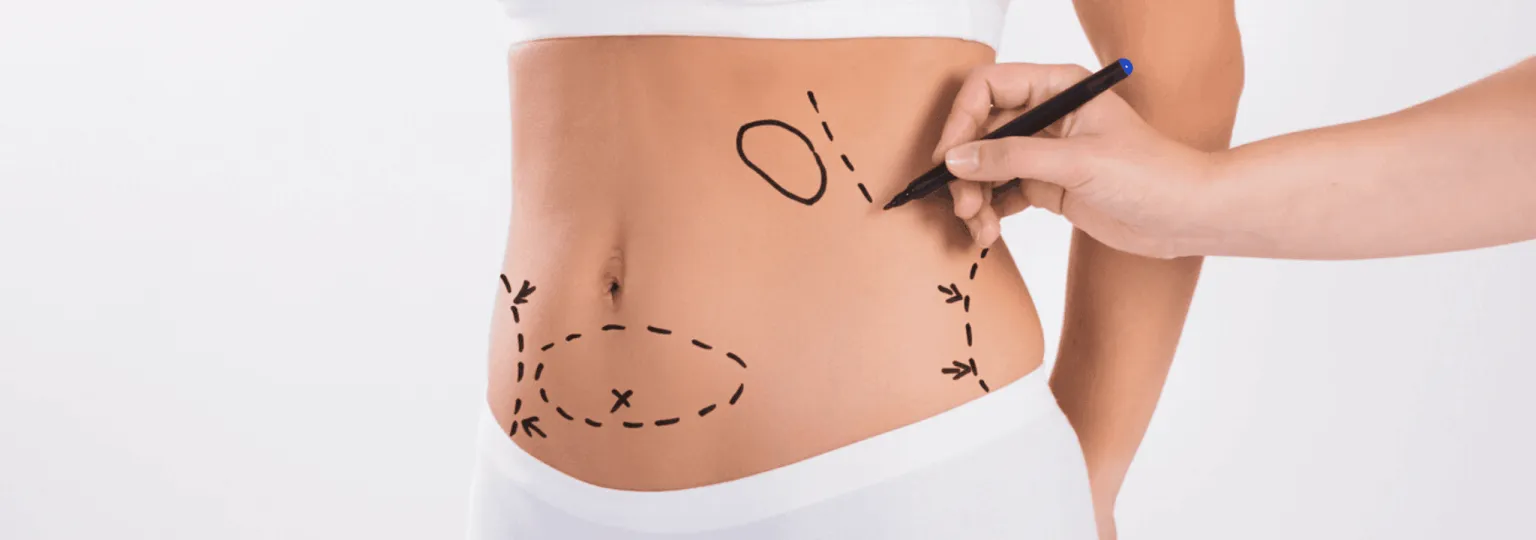 liposuction